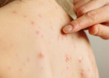 زنگ خطر سرخک برای همه استان‌های ایران